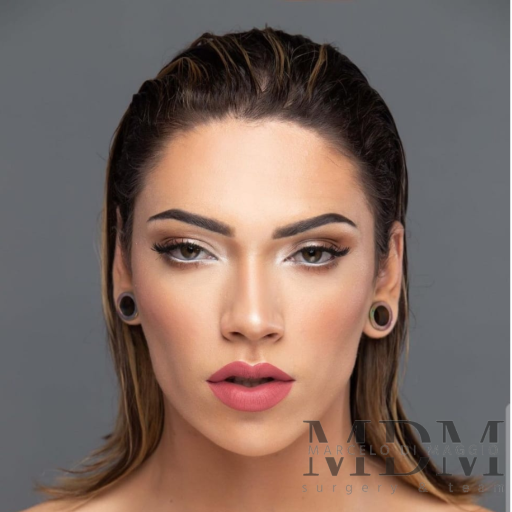 Rejuvenation-Feminization-FFS-Harmonization