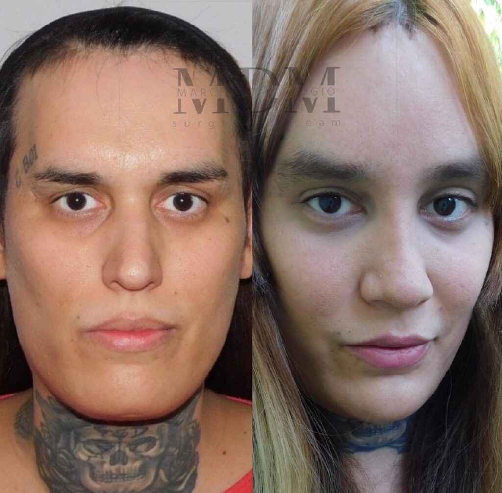 FFS-Menton-Chin-Osteotomy-remodeling-Vera