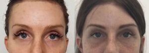Feminization-Harmonization-chin-jaw-eyes expression-Complication1 - Copy