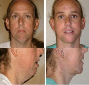 Rejuvenation-Feminization-FFS-Harmonization-Facelift
