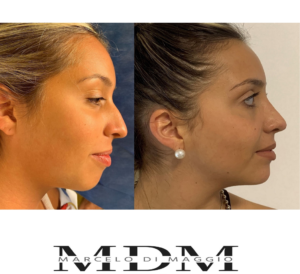 rhinoplasty-nariz